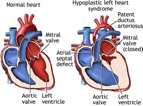 lv hypoplasia|hypoplastic left heart norwood procedure.